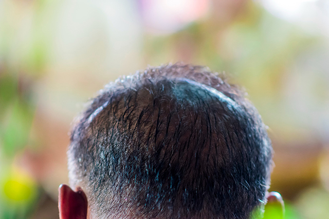 greffe de cheveux après 3 semaines