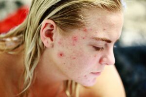 Acné Hormonale Femme